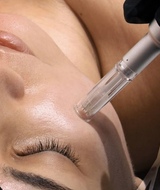 Book an Appointment with Microneedling Avec Exosomes + PDRN at La clinique Versa MD situé à Montréal